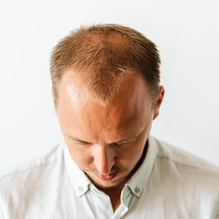 GHK-Cu Peptides for Hair Growth in Men